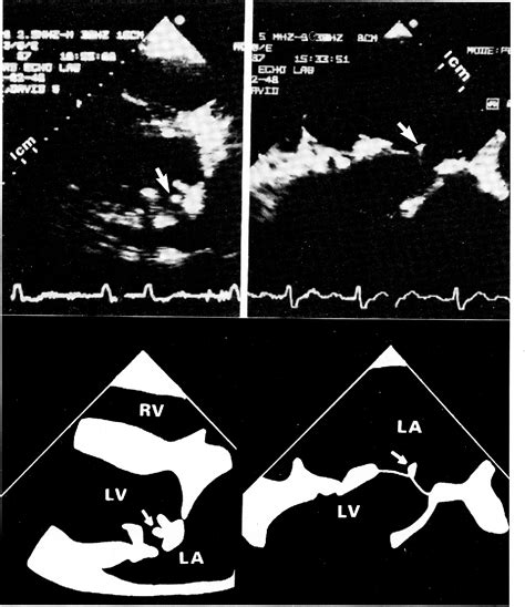 Figure 1 From Transesophageal Two Dimensional Echocardiography And