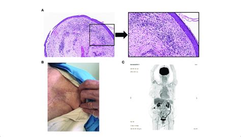 Resolution Of Cutaneous Metastasis Following Intralesional Il And