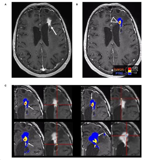 Posttreatment Changes On Dsc Mri A Year Old Woman With Left