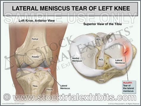 Lateral Meniscus Tear Of Left Knee Stock Trial Exhibits