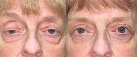 Ptosis Repair Archives Eyelid Center Of Utah