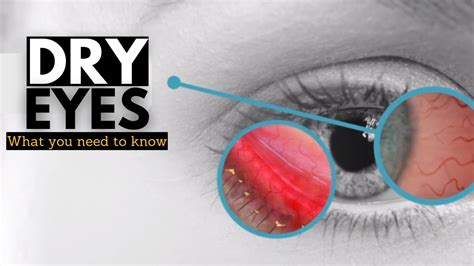 Dry Eye Syndrome Causes Signs And Symptoms Diagnosis And Treatment