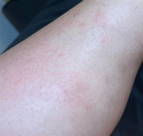 Itchy, painful rash on shin - Help identifying? : r/DermatologyQuestions