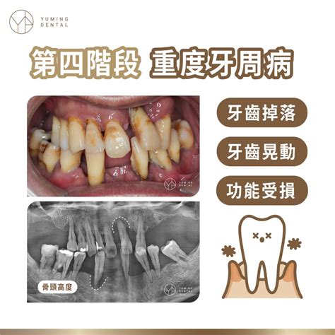 牙齦流血 是牙周病前兆！？什麼是牙周病？常見症狀與治療方式介紹