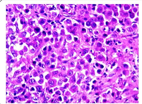 Decidual Tumor Cells With Large Eosinophilic Cytoplasm And Prominent