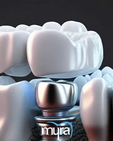 Dental Implant Abutment: Definition, Uses, Types and Procedures