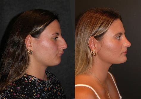 Rhinoplasty Before And After Dr Andrew Jacono Rhinoplasty