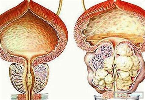 All about prostate adenoma: causes,symptoms, treatment, prognosis ...