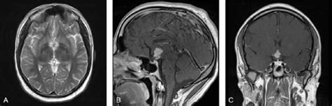 Preoperative Magnetic Resonance Imaging A T2 Weighted Image Depicts