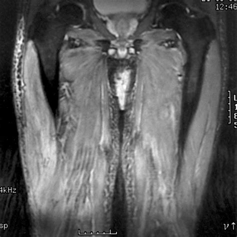 T 2 Weighted Magnetic Resonance Image An Increased Signal Density In