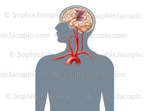 AVC Illustration Medicale Sophie Jacopin