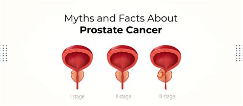 Myths And Facts About Prostate Cancer