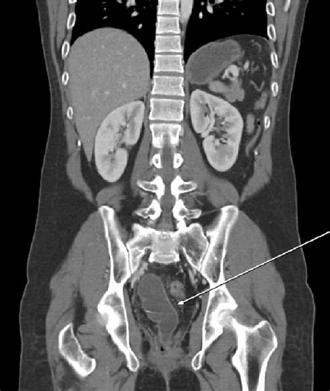 Figure 2 From Reconstruction Of A Completely Obstructed Rectosigmoid Vaginal Introitus In A