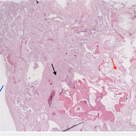 Post Resection Pathology Of Dermoid Cyst A Epidermal Cysts With Thin