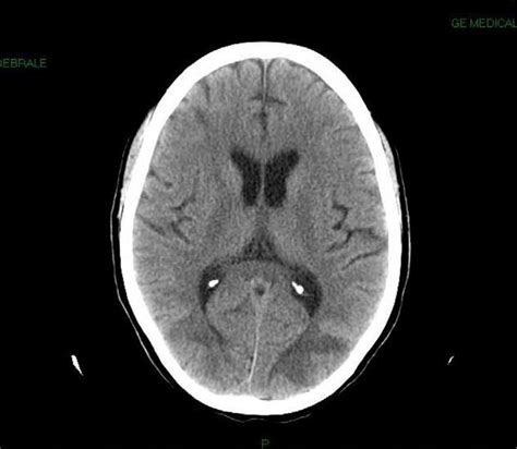Tc Senza Mezzo Di Contrasto Ipodensit Diffusa Della Sostanza Bianca