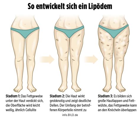 Vereinfachen visuell Unabhängig lipödem unterwäsche Nach vorne