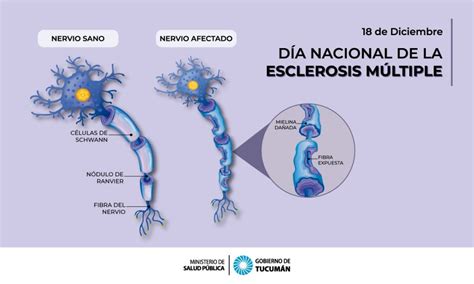 18 De Diciembre Día Nacional De La Esclerosis Múltiple Ministerio De Salud Pública De Tucumán