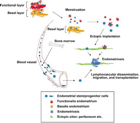 Figure 2 From Stem Cell Theory For The Pathogenesis Of Endometriosis