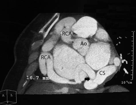 Computed Tomographic Angiogram Shows Large Circumvolved Right Coronary