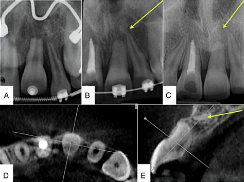 The Radiographic Examination Intraoral Radiographs Of Maxillary