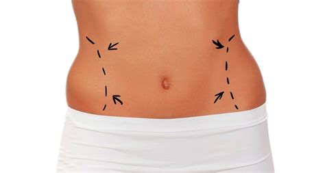 Your Guide To Understanding Liposuction Scars