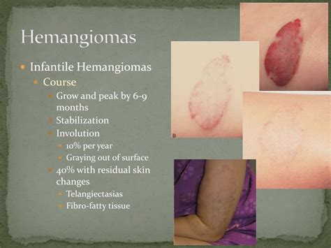 Ppt Hemangiomas And Vascular Malformations Powerpoint Presentation