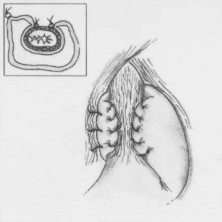 Technique of the Toupet (270°, posterior) fundoplication | Download Scientific Diagram