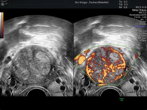 Uterus Galerie Fach Rzte F R Frauenheilkunde Bielefeld Kr Ger Fischer