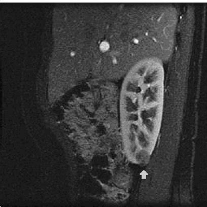 On Contrast Enhanced Fat Saturated T Weighted Sagittal Mr Images