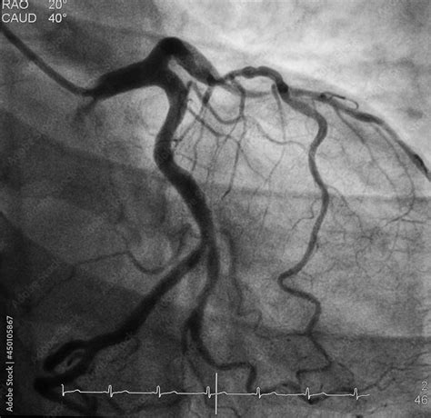 Coronary Angiogram CAG Was Showed Left Anterior Descending Artery