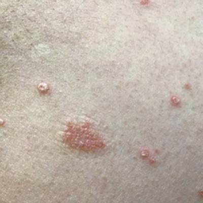 Guttate Psoriasis Following Covid Infection Mdedge Dermatology