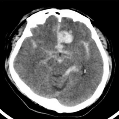 Brain Computed Tomography Demonstrated Subarachnoid Hemorrhage In The