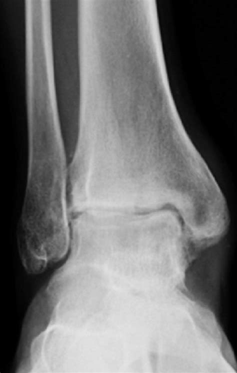 Ankle Arthrodesis - Foot & Ankle - Orthobullets