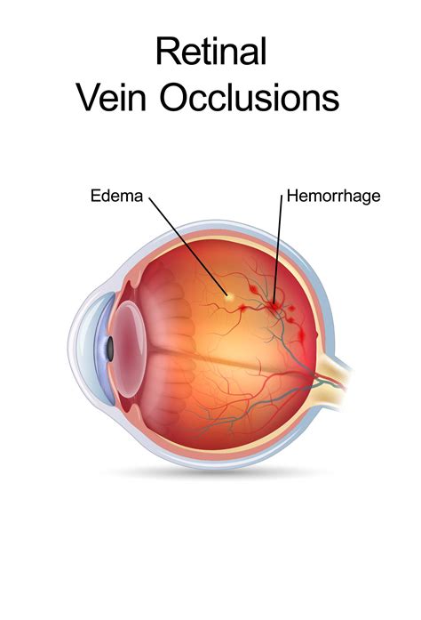 How Retinal Vein Occlusion (RVO) Can Be Managed and Treated | Retina