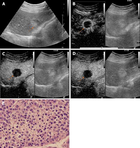 Hepatocellular Carcinoma Ultrasound