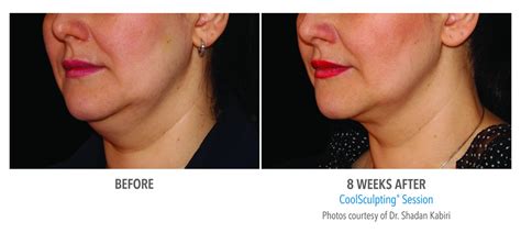 CoolSculpting Face / Neck Before and After Photos NYC