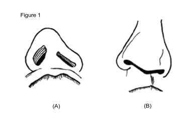 Cleft Lip Nasal Deformity Practice Essentials History Of The