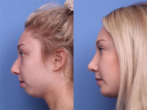 Caring For A Nose Cast After Rhinoplasty Phoenix And Scottsdale Az Dr Todd Hobgood