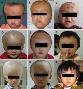 Macrocephaly: Symptoms, Causes, Treatment | Its Psychology