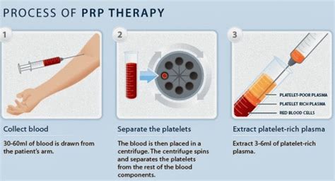 PRP Treatment - BELLVS