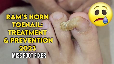 Ram S Horn Toenail Causes Treatment And Prevention Tips By Foot