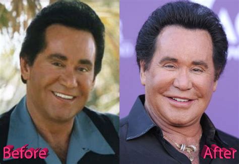 Wayne Newton Plastic Surgery: A Las Vegas Facelift