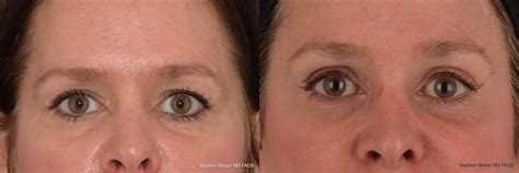 Brow Lift Before And After Weber Facial Plastic Surgery