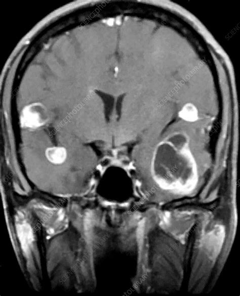 Melanoma Metastatic to Brain, MRI - Stock Image - C039/4207 - Science ...