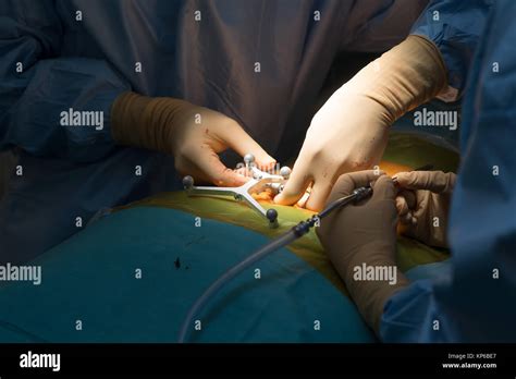 La chirurgie de la colonne vertébrale Photo Stock - Alamy