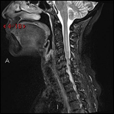 Longitudinally Extensive Transverse Myelitis A Rare Neuromyelitis