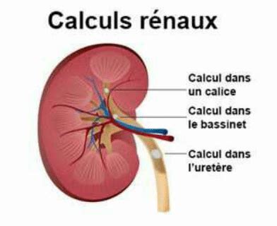 Calculs rénaux Une maladie à prendre en charge rapidement