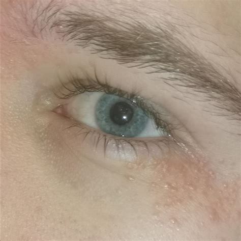 What Are These Red Bumps Around My Eye Help R Dermatologyquestions