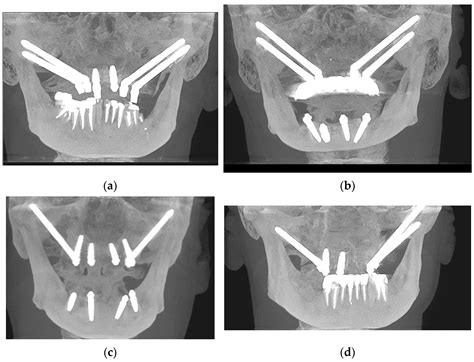 Jcm Free Full Text The Zygomatic Anatomy Guided Approach Zygomatic