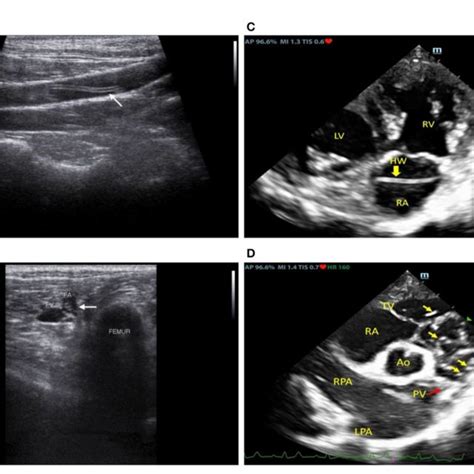 FIGURE Ultrasonographic images at the left external iliac artery (A ...